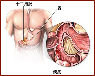 胃溃疡有哪些症状怎么治疗更有效