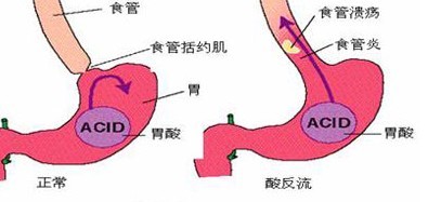 反流性食管炎的治疗